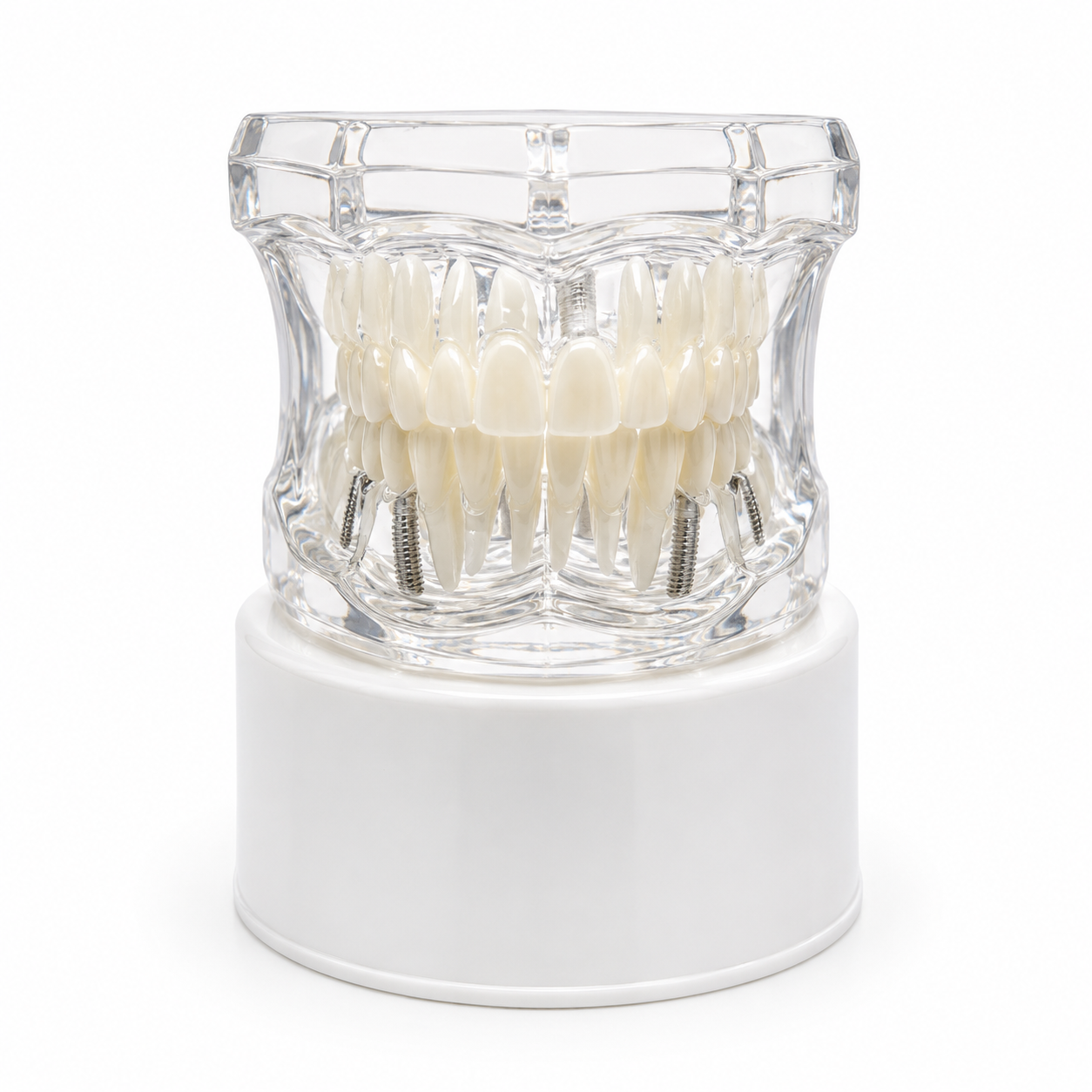 Maqueta Dental Transparente de Tratamientos con Implantes, Coronas e Incrustaciones Maqueta Dental Transparente de Tratamientos con Implantes, Coronas e Incrustaciones