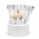 Maqueta Dental Transparente de Tratamientos con Implantes, Coronas e Incrustaciones