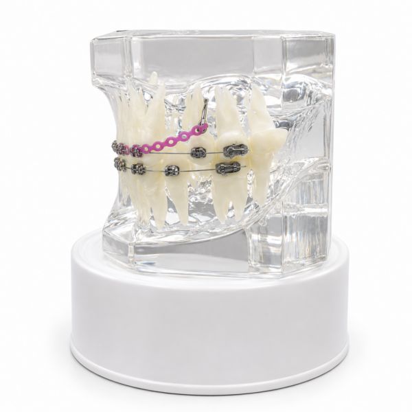 Maqueta Dental Transparente de Ortodoncia con Brackets y Microtornillos