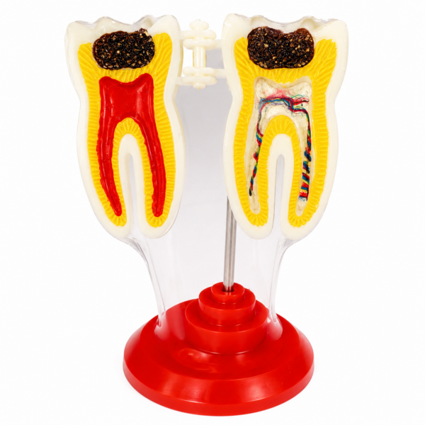 Modelo Anatómico Dental Acrílico: Patología de Caries y Endodoncia